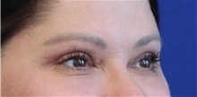 Eyelid Surgery After Photo by Munique Maia, MD; Tysons Corner, VA - Case 48822