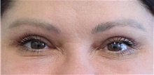 Eyelid Surgery After Photo by Munique Maia, MD; Tysons Corner, VA - Case 48822