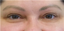 Eyelid Surgery Before Photo by Munique Maia, MD; Tysons Corner, VA - Case 48822