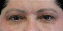 Eyelid Surgery Before Photo by Munique Maia, MD; Tysons Corner, VA - Case 48822