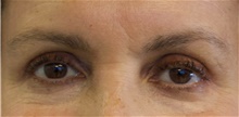 Eyelid Surgery After Photo by Munique Maia, MD; Tysons Corner, VA - Case 48823