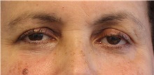 Eyelid Surgery Before Photo by Munique Maia, MD; Tysons Corner, VA - Case 48823