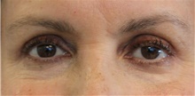 Eyelid Surgery After Photo by Munique Maia, MD; Tysons Corner, VA - Case 48823