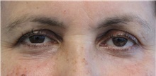 Eyelid Surgery Before Photo by Munique Maia, MD; Tysons Corner, VA - Case 48823