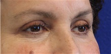 Eyelid Surgery After Photo by Munique Maia, MD; Tysons Corner, VA - Case 48823