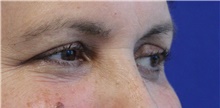 Eyelid Surgery Before Photo by Munique Maia, MD; Tysons Corner, VA - Case 48823