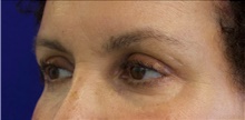 Eyelid Surgery After Photo by Munique Maia, MD; Tysons Corner, VA - Case 48823