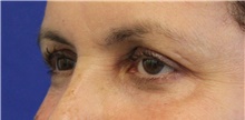 Eyelid Surgery Before Photo by Munique Maia, MD; Tysons Corner, VA - Case 48823