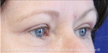 Eyelid Surgery After Photo by Munique Maia, MD; Tysons Corner, VA - Case 48824