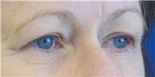 Eyelid Surgery Before Photo by Munique Maia, MD; Tysons Corner, VA - Case 48824