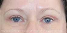 Eyelid Surgery After Photo by Munique Maia, MD; Tysons Corner, VA - Case 48824