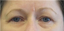 Eyelid Surgery Before Photo by Munique Maia, MD; Tysons Corner, VA - Case 48824