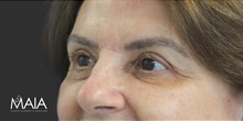 Eyelid Surgery After Photo by Munique Maia, MD; Tysons Corner, VA - Case 48828