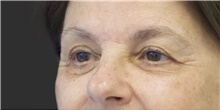 Eyelid Surgery Before Photo by Munique Maia, MD; Tysons Corner, VA - Case 48828