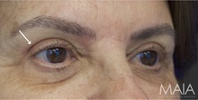 Eyelid Surgery After Photo by Munique Maia, MD; Tysons Corner, VA - Case 48828