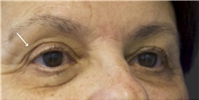 Eyelid Surgery Before Photo by Munique Maia, MD; Tysons Corner, VA - Case 48828