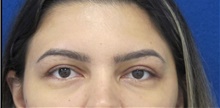 Eyelid Surgery After Photo by Munique Maia, MD; Tysons Corner, VA - Case 48830