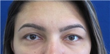 Eyelid Surgery Before Photo by Munique Maia, MD; Tysons Corner, VA - Case 48830