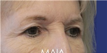 Eyelid Surgery Before Photo by Munique Maia, MD; Tysons Corner, VA - Case 48832