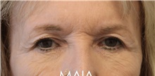 Eyelid Surgery Before Photo by Munique Maia, MD; Tysons Corner, VA - Case 48832