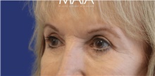 Eyelid Surgery After Photo by Munique Maia, MD; Tysons Corner, VA - Case 48832