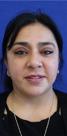 Eyelid Surgery After Photo by Munique Maia, MD; Tysons Corner, VA - Case 48833