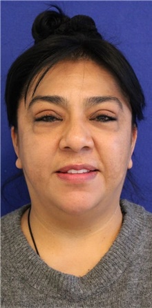 Eyelid Surgery Before Photo by Munique Maia, MD; Tysons Corner, VA - Case 48833