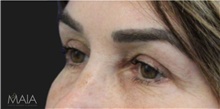Eyelid Surgery After Photo by Munique Maia, MD; Tysons Corner, VA - Case 48836