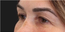 Eyelid Surgery Before Photo by Munique Maia, MD; Tysons Corner, VA - Case 48836