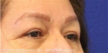 Eyelid Surgery After Photo by Munique Maia, MD; Tysons Corner, VA - Case 48838