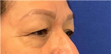 Eyelid Surgery Before Photo by Munique Maia, MD; Tysons Corner, VA - Case 48838