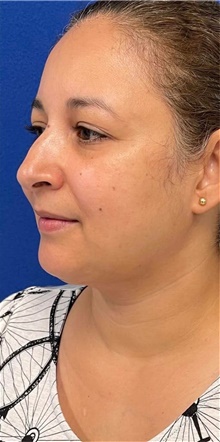 Liposuction After Photo by Munique Maia, MD; Tysons Corner, VA - Case 48845
