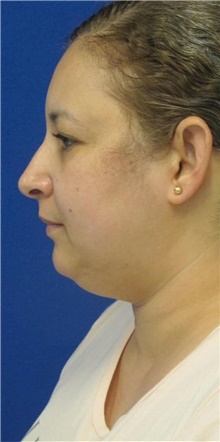 Liposuction Before Photo by Munique Maia, MD; Tysons Corner, VA - Case 48845