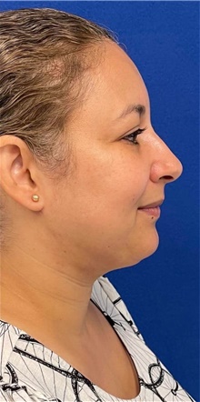 Liposuction After Photo by Munique Maia, MD; Tysons Corner, VA - Case 48845
