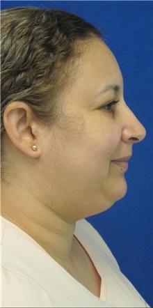 Liposuction Before Photo by Munique Maia, MD; Tysons Corner, VA - Case 48845