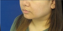 Liposuction After Photo by Munique Maia, MD; Tysons Corner, VA - Case 48846