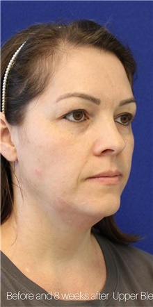 Liposuction Before Photo by Munique Maia, MD; Tysons Corner, VA - Case 48847