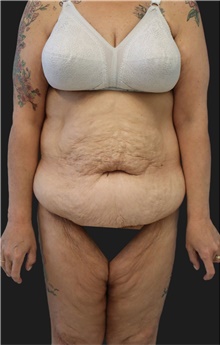 Tummy Tuck Before Photo by Munique Maia, MD; Tysons Corner, VA - Case 48848