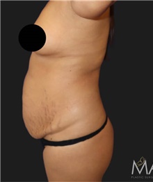Tummy Tuck Before Photo by Munique Maia, MD; Tysons Corner, VA - Case 48849