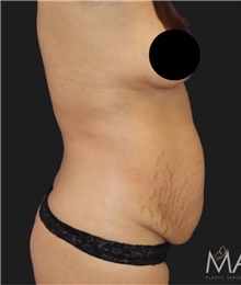 Tummy Tuck Before Photo by Munique Maia, MD; Tysons Corner, VA - Case 48849