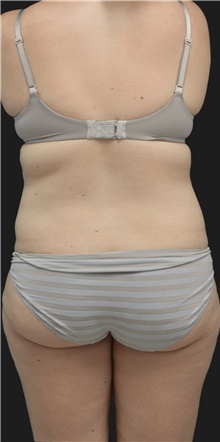 Liposuction Before Photo by Munique Maia, MD; Tysons Corner, VA - Case 48854