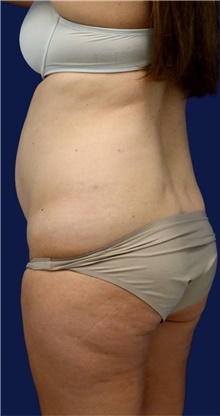 Liposuction Before Photo by Munique Maia, MD; Tysons Corner, VA - Case 48855