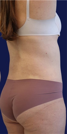 Liposuction After Photo by Munique Maia, MD; Tysons Corner, VA - Case 48855