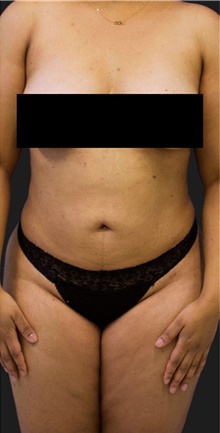 Liposuction After Photo by Munique Maia, MD; Tysons Corner, VA - Case 48860