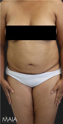Liposuction Before Photo by Munique Maia, MD; Tysons Corner, VA - Case 48860