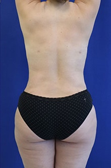 Liposuction After Photo by Munique Maia, MD; Tysons Corner, VA - Case 48861