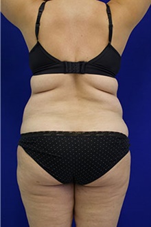 Liposuction Before Photo by Munique Maia, MD; Tysons Corner, VA - Case 48861