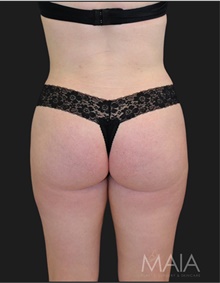 Liposuction After Photo by Munique Maia, MD; Tysons Corner, VA - Case 48867
