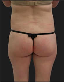 Liposuction Before Photo by Munique Maia, MD; Tysons Corner, VA - Case 48867