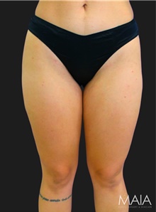 Liposuction After Photo by Munique Maia, MD; Tysons Corner, VA - Case 48868
